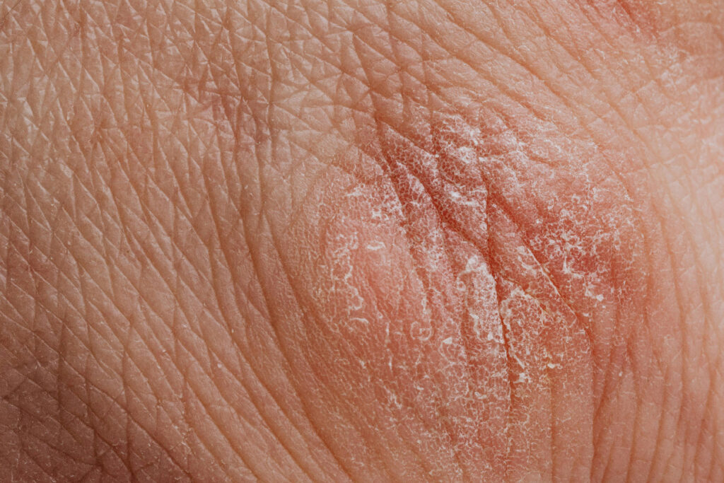 Hauterkrankung © https://www.pexels.com/photo/close-up-view-of-human-dry-skin-4046564/